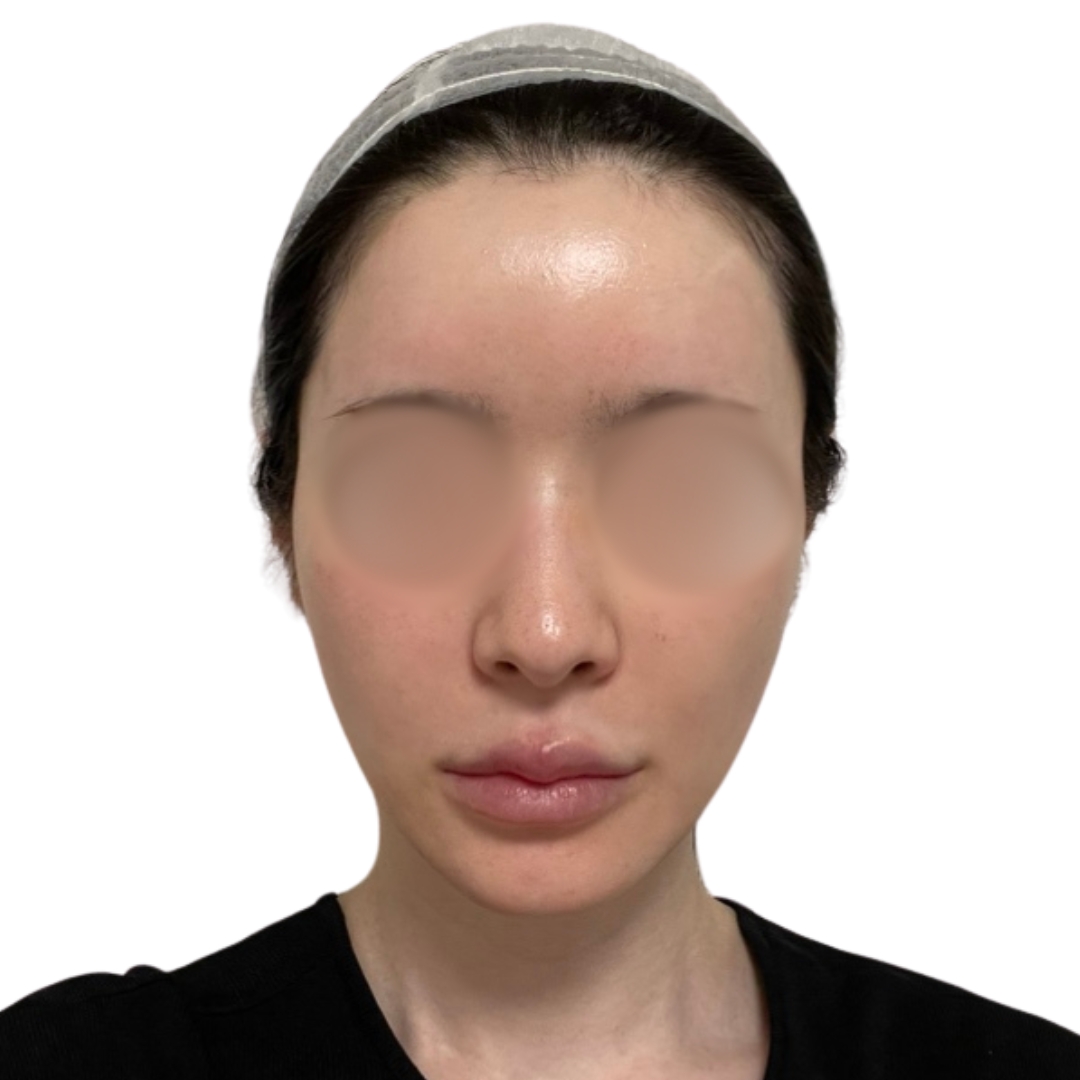 エクソソームフェイシャル